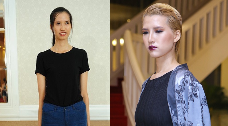 A quan Next Top cao 1,9 m bi nghi phau thuat tham my hinh anh