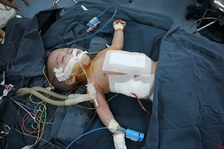 Phau thuat thanh cong cap song sinh dinh lien phan bung hinh anh