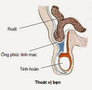 Thoát vị bẹn do sự ‘di chuyển’ của ruột, mạc nối hay buồng trứng vào trong ống bẹn