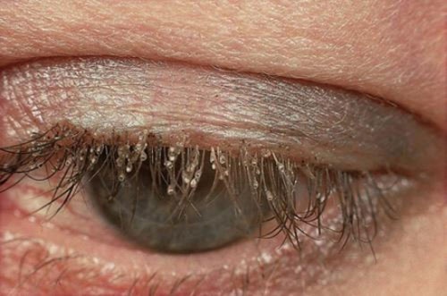 Loại rận này xuất hiện cả ở mi mắt