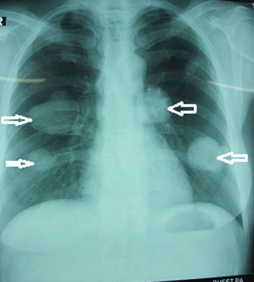 Loại sán chó chỉ có thể nhìn bằng kính hiển vi, có thể gây tử vong cho người bệnh - ảnh: chụp phổi bệnh nhân là cán bộ y tế bị sán chó làm tổ trong 2 bên phổi
