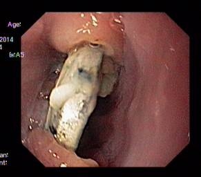 Cục pin tròn găm vào thành thực quản - ảnh Khánh Chi (Viên Nhi TW)