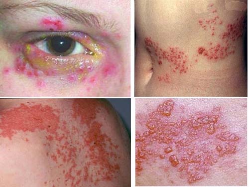 bệnh nhận bị mò đốt - ảnh Tư liệu