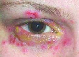 Sot mo, can benh bi lang quen da tro lai hinh anh