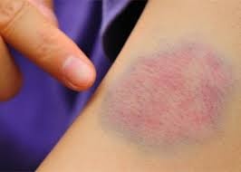 Bệnh nhận bị rối loạn đông máu thường xuất huyết các vệt bầm tím - ảnh: minh họa