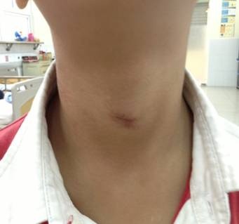 Be 7 tuoi ngung tim do bi rem cua thit ngat tho hinh anh