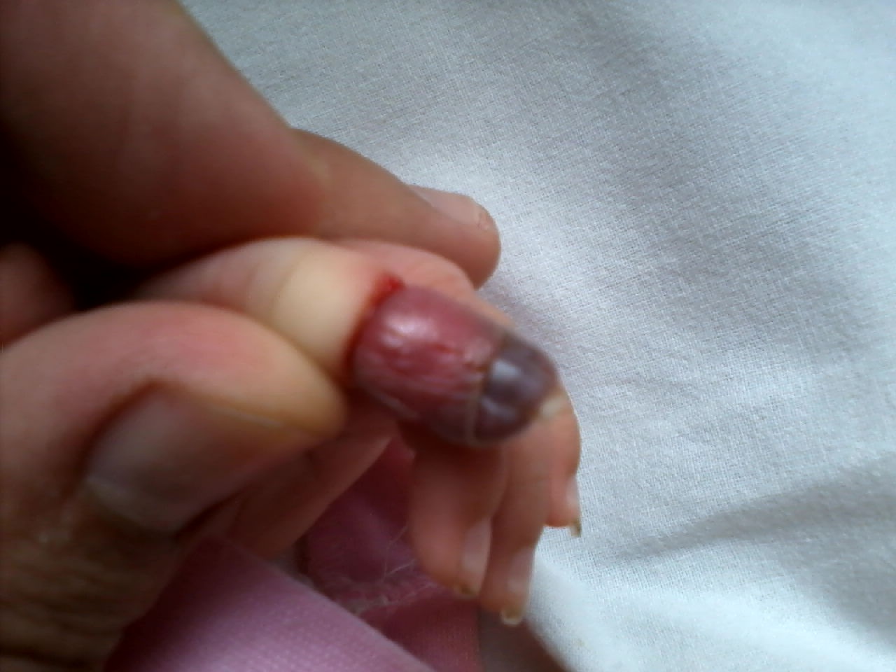 Quen thao garo, benh nhi bi hoai tu ban tay hinh anh