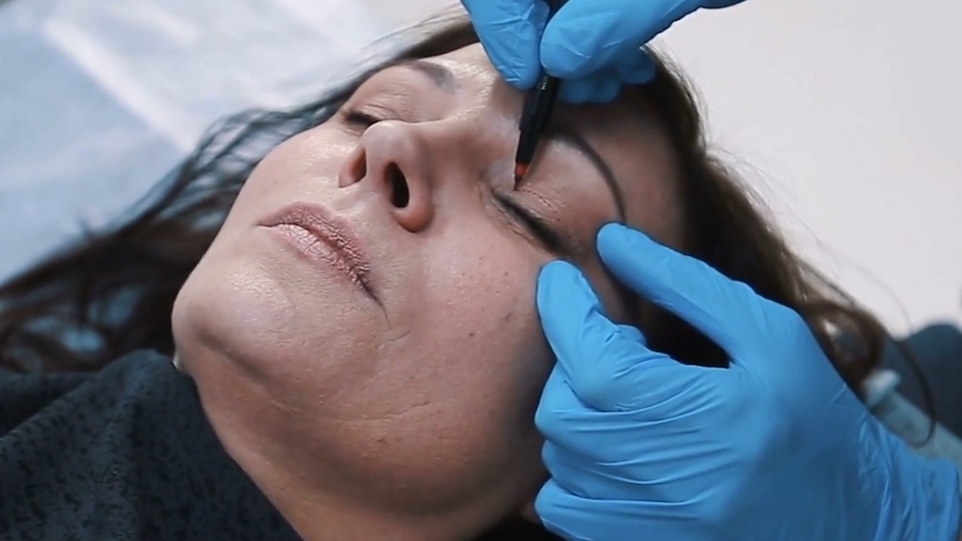 con sot phau thuat tham my anh 1