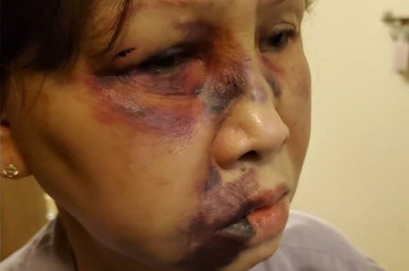 Nguoi phu nu My goc Viet bi danh gay xuong mat hinh anh