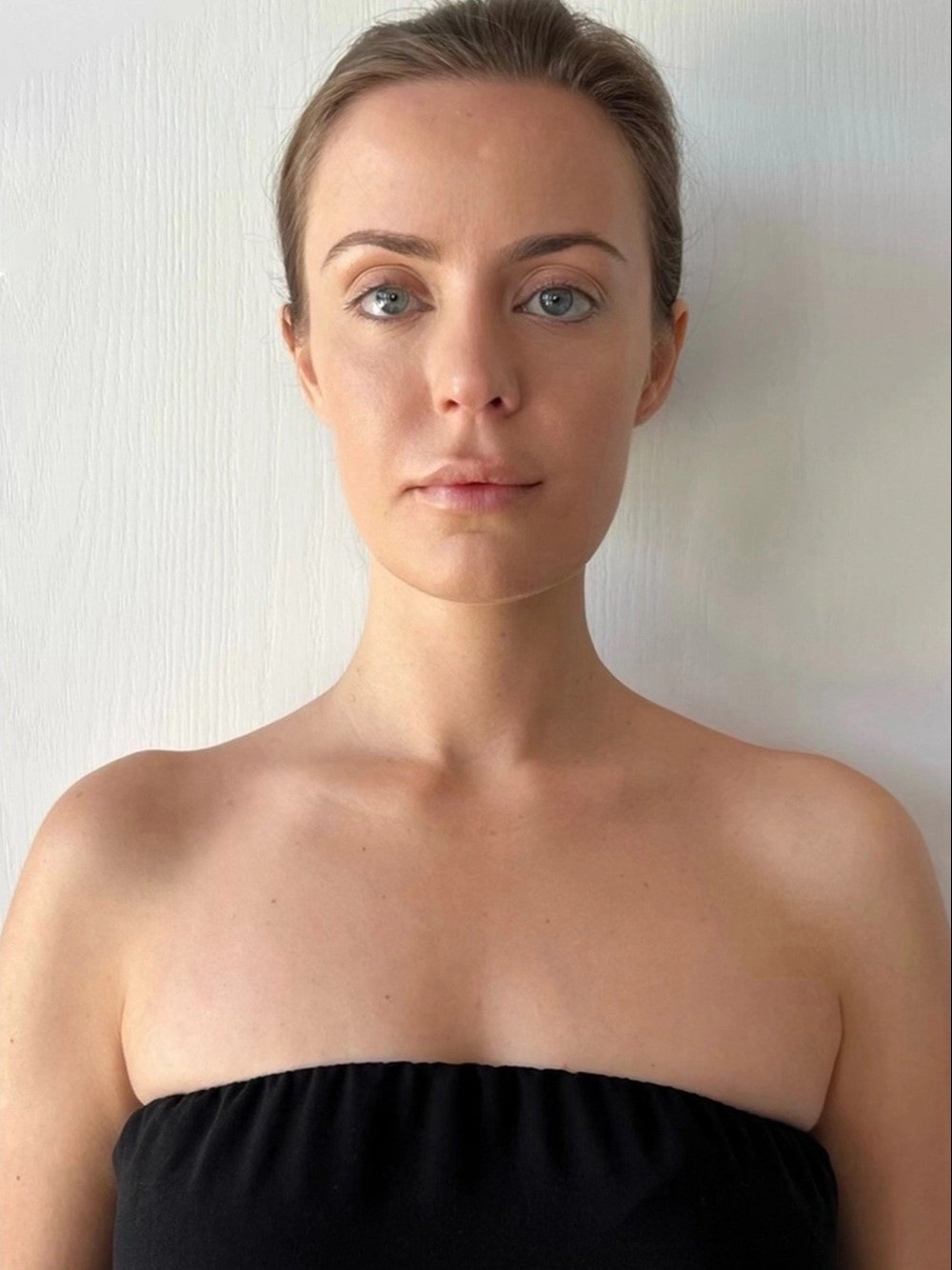 tiêm botox ảnh 3 tiem botox anh 3