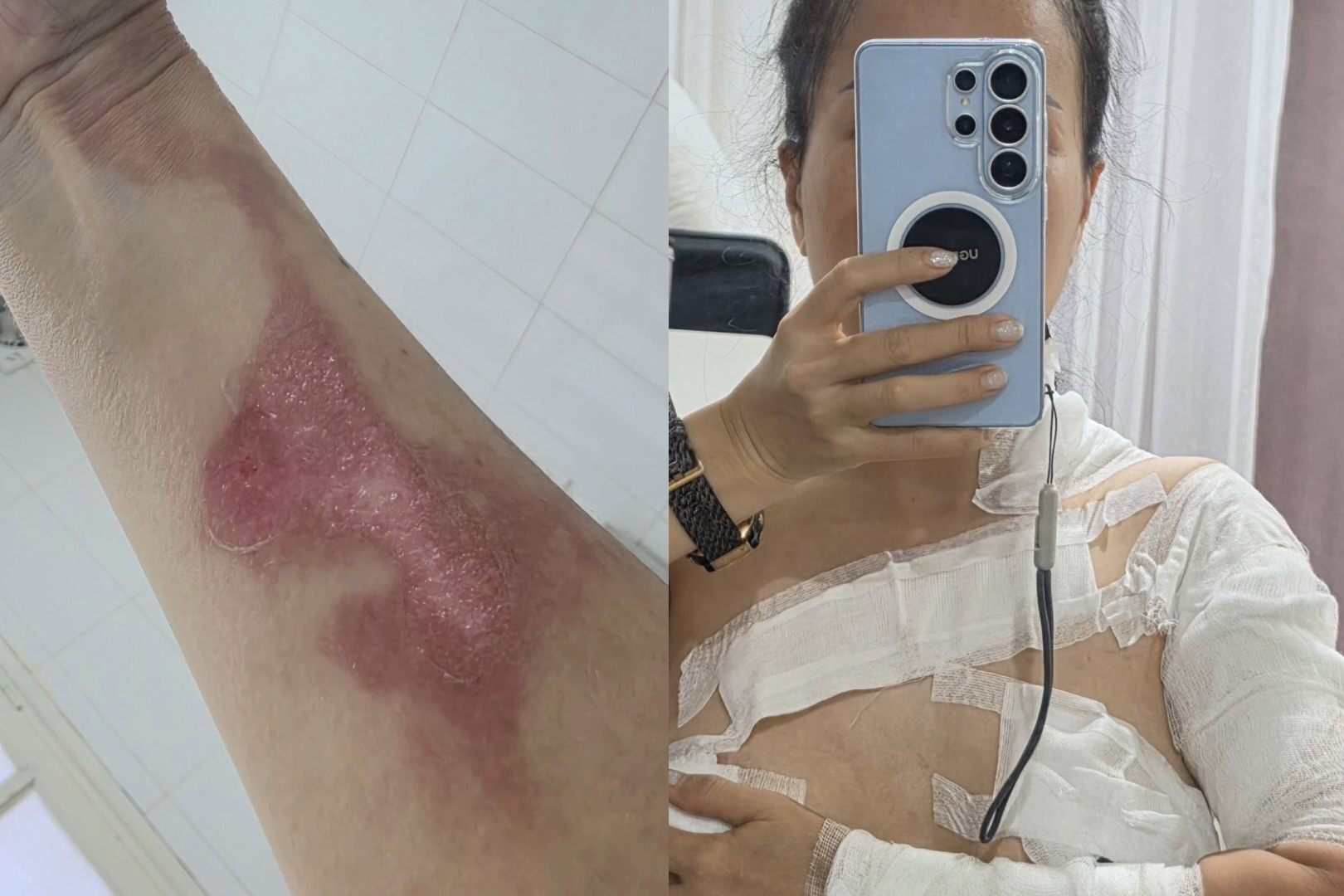 No noi xong hoi khi goi dau duong sinh, khach nu bi bong do 2 hinh anh