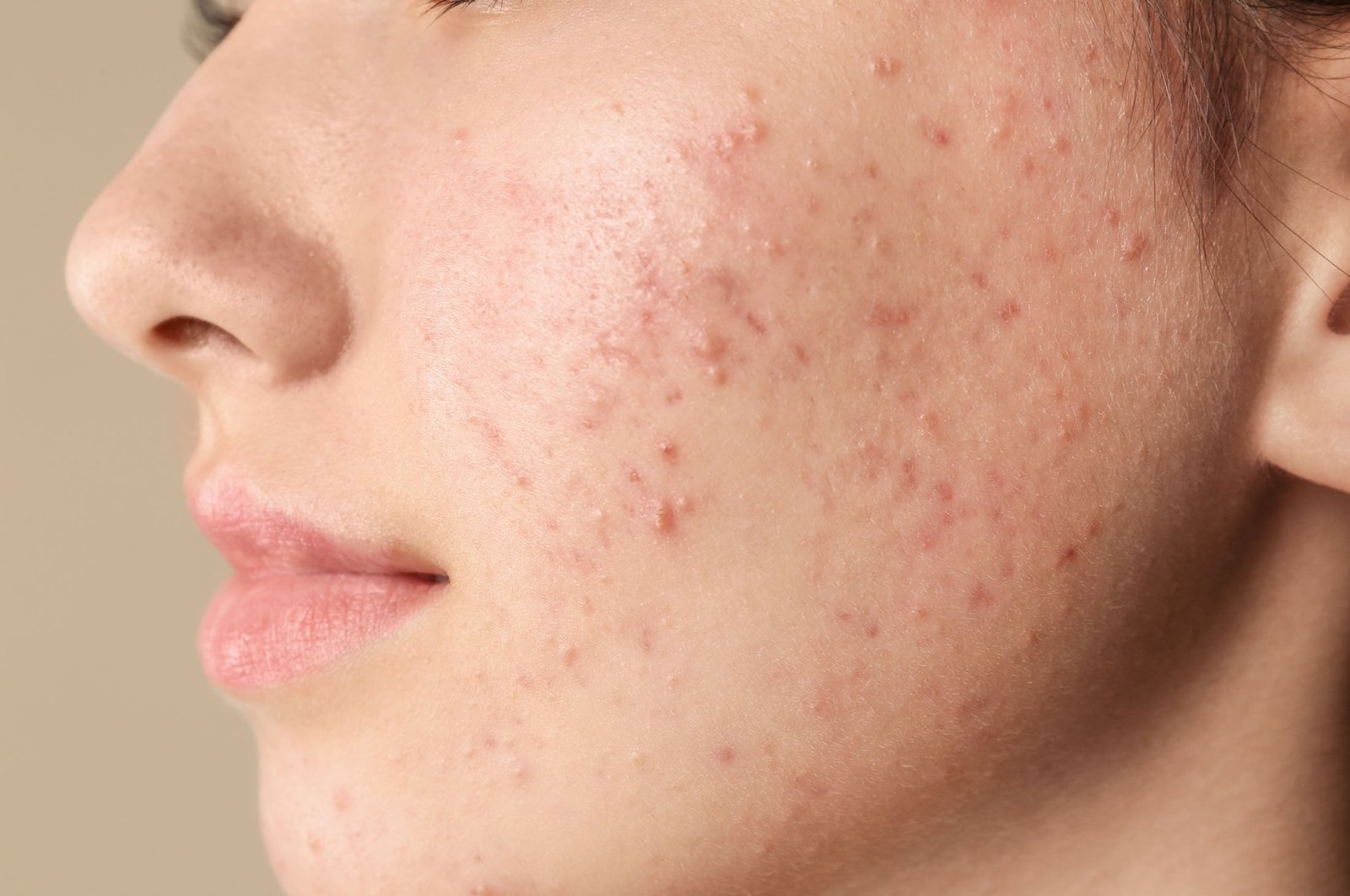 Cham da mun tuoi day thi the nao la dung? hinh anh