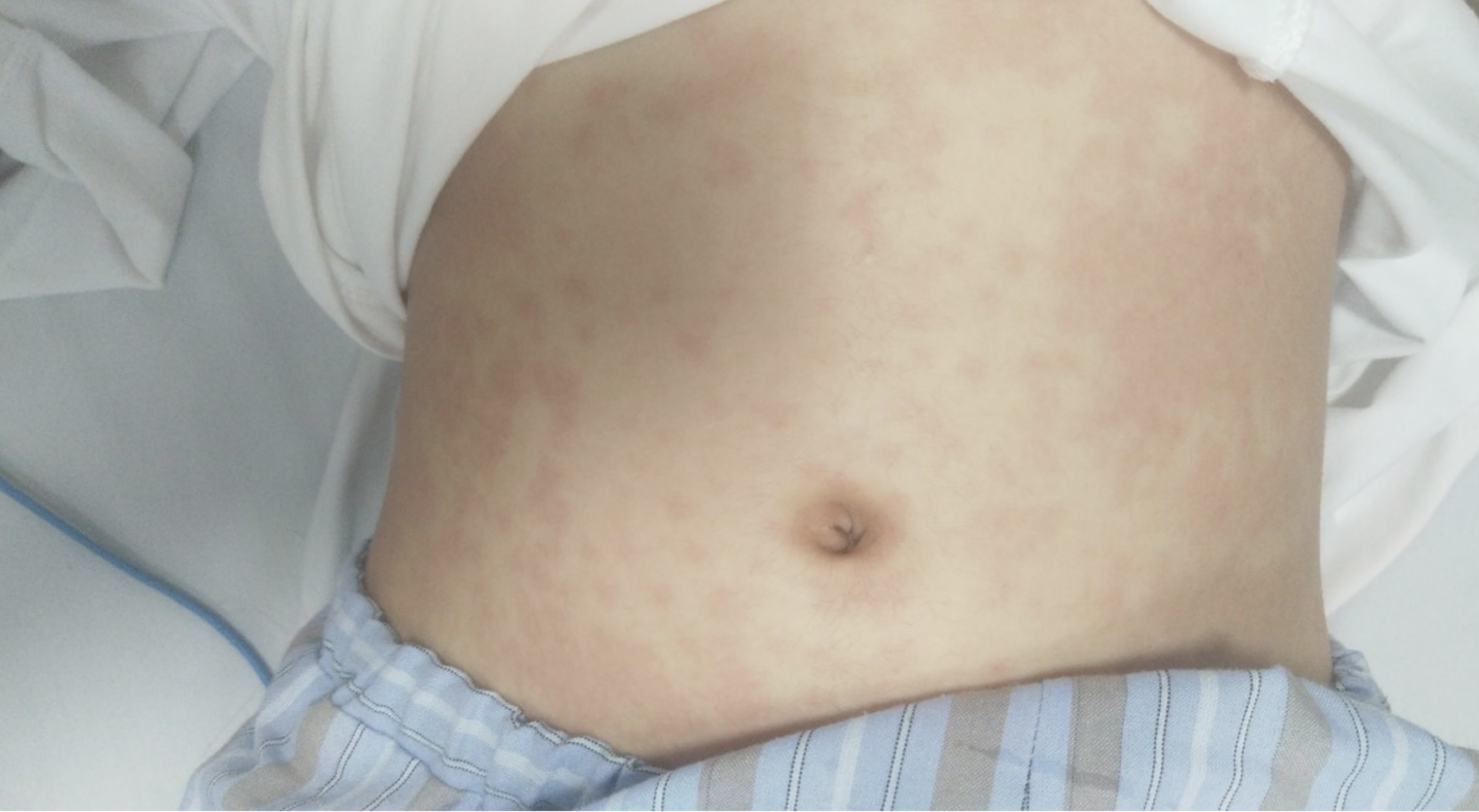 Ton thuong phoi nang sau 2 tuan khoi Covid-19 hinh anh