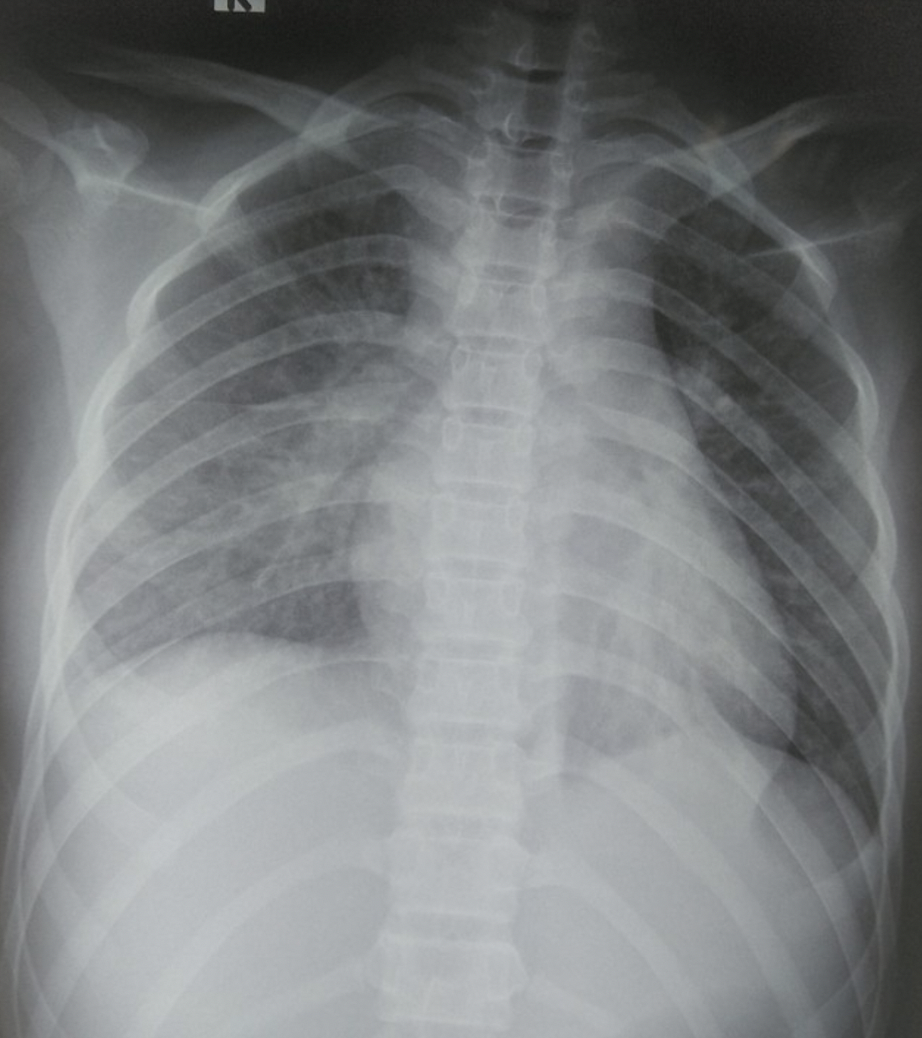 Be gai ton thuong phoi hau Covid-19 anh 1