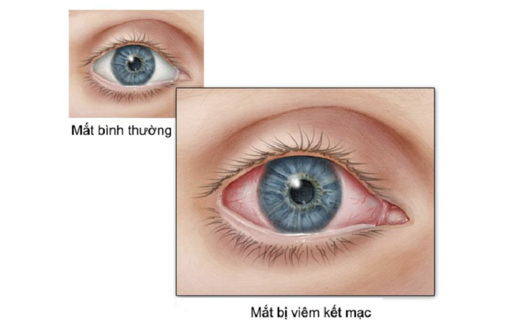 Canh giac khi tre bi viem ket mac hau Covid-19 anh 1