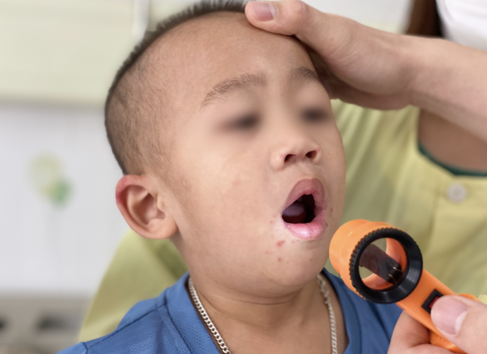 Dau hieu tre mac tay chan mieng phai nhap vien anh 1