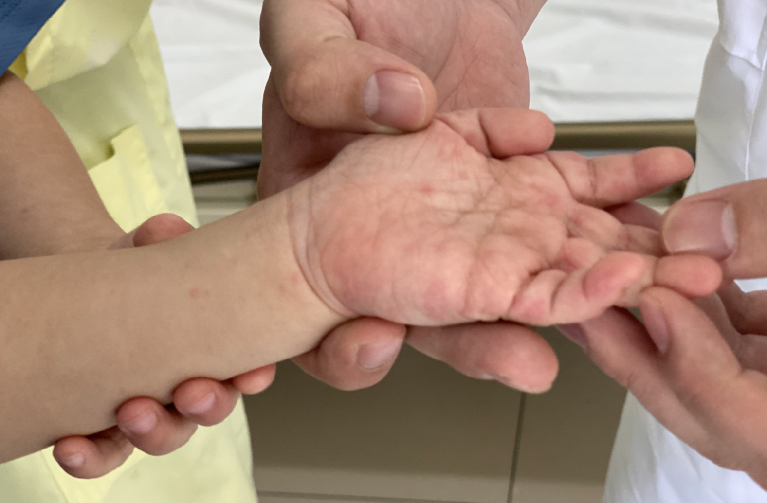 Dau hieu tre mac tay chan mieng can nhap vien hinh anh