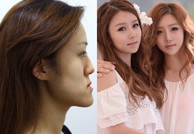 Nhung cap chi em cung hoa thien nga sau phau thuat tham my hinh anh