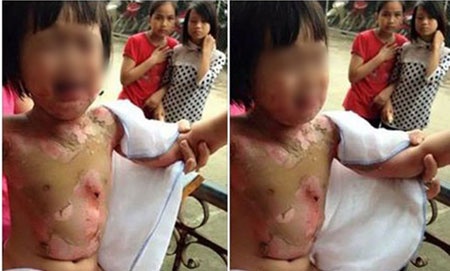 Be gai bi ban dot bong nua nguoi o truong mam non hinh anh