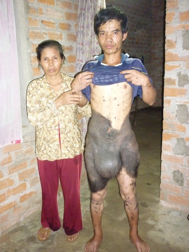 Chang trai co 'lop da trau' o Binh Dinh hinh anh