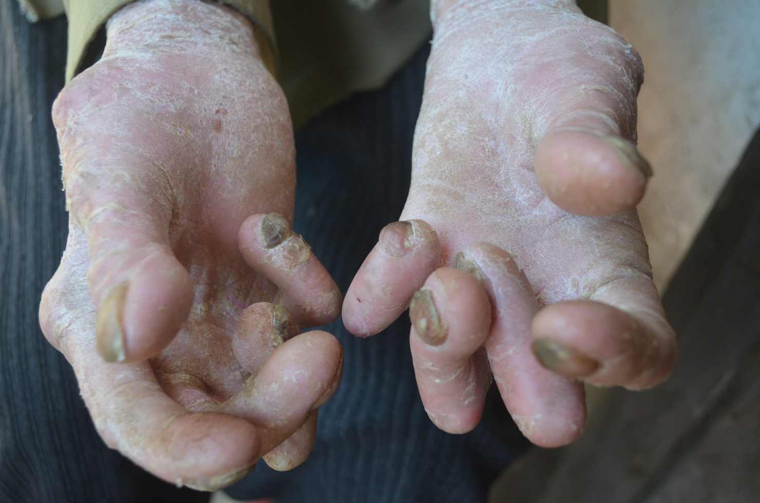 Tam su cua cha con 'nguoi ran' o Quang Nam hinh anh