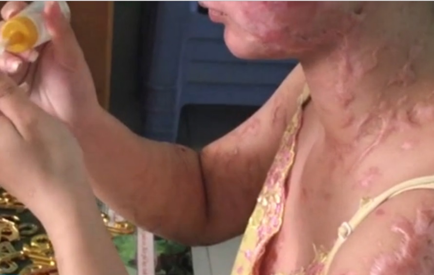 Tam su buon cua co gai chi chit vet seo do bi tat axit hinh anh