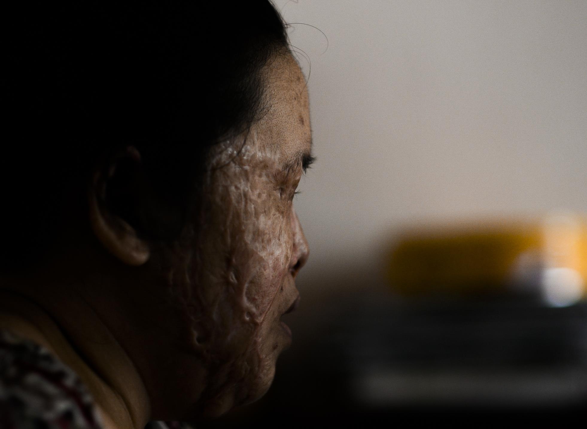 nan nhan vu tat axit anh 1