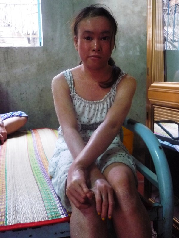 Thieu nu 17 tuoi bi can benh lot da toan than o mien Tay hinh anh