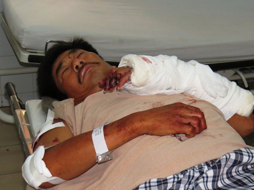 Tram truong bao ve rung bi chem gan dut lia ban tay hinh anh