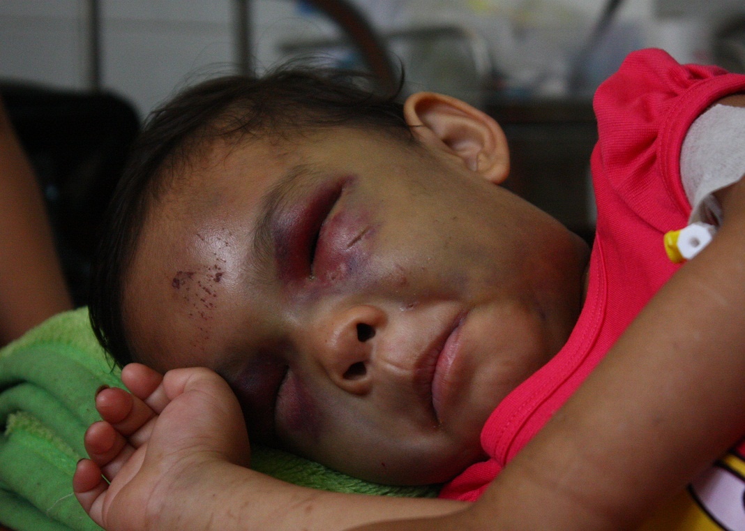 Bé Ngân bị ba mẹ đánh bầm tím hai mắt.