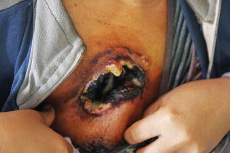 Cận cảnh vết thương do căn bệnh ung thư di căn của chị Bích (đây cũng là nơi để ông Bi xông khói chữa bệnh cho chị Bích). 