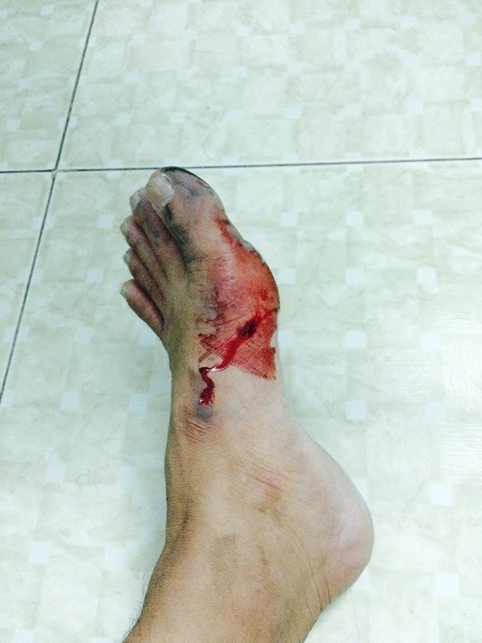 Anh bị trầy xước và chảy máu chân.