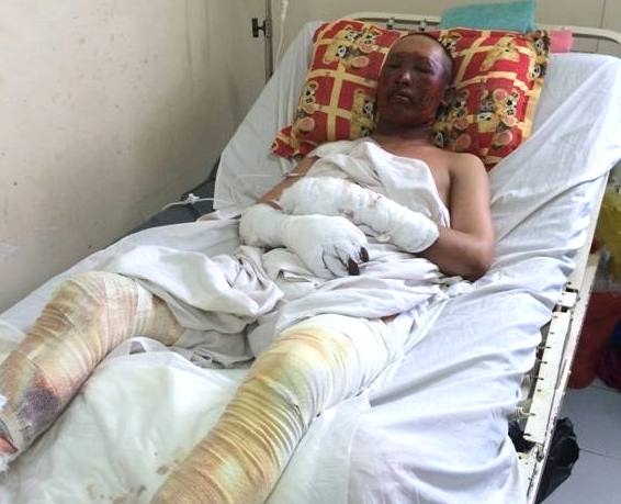 No lo nung, 2 cong nhan bi thep vang vao nguoi hinh anh