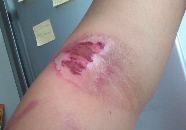 Một người dân bị kiến cắn gây thương tích. Ảnh: NDCC.