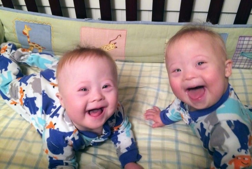 Nu cuoi ngay tho cua cap song sinh mac hoi chung Down hinh anh