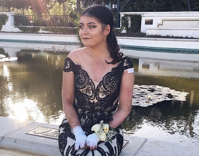 Co gai mac hoi chung lan da canh buom anh 1