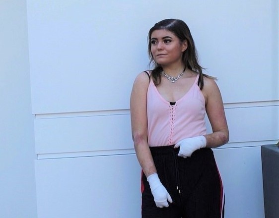 Co gai mac hoi chung lan da canh buom anh 10