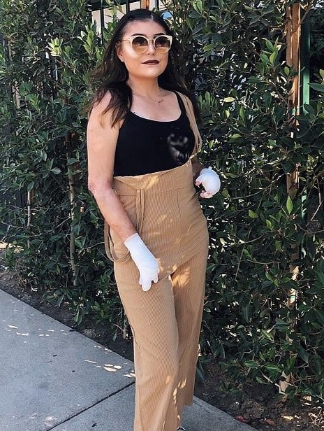 Co gai mac hoi chung lan da canh buom anh 7