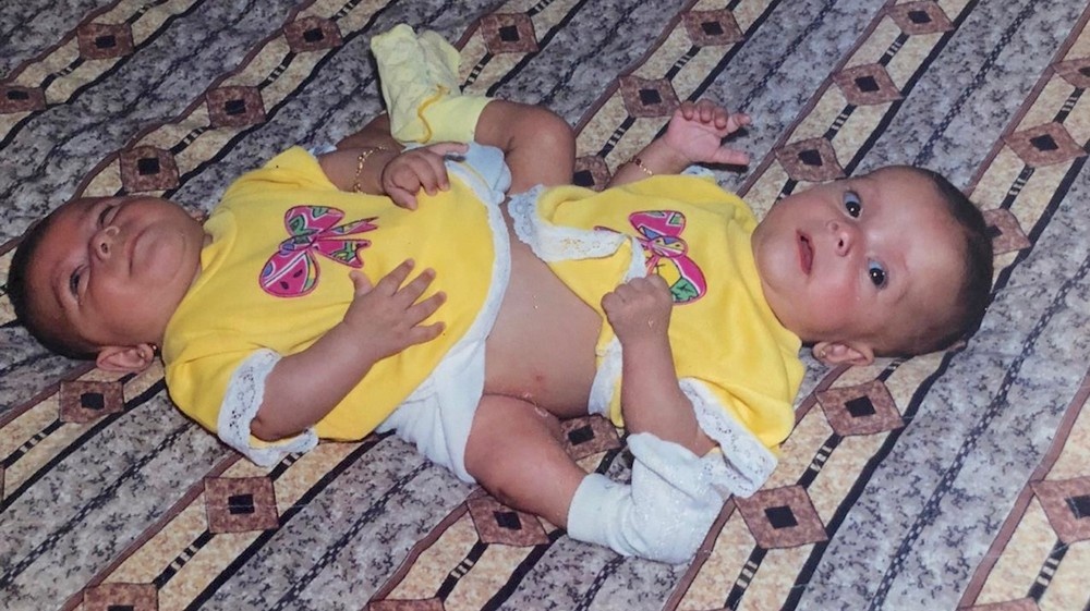 Co gai duoc tach roi tu nguoi chi song sinh uoc mo tro thanh bac si anh 1