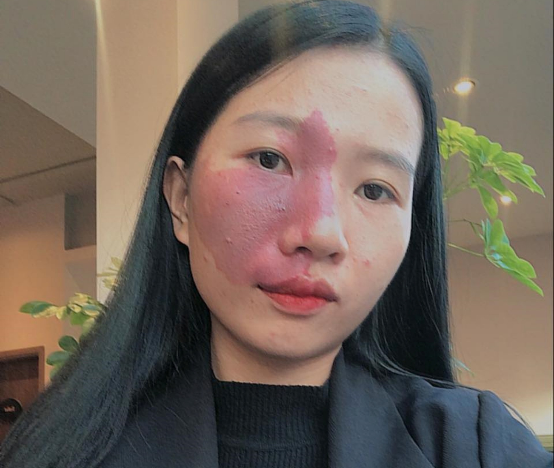 cô giáo có vết bớt ảnh 1 co giao co vet bot anh 1