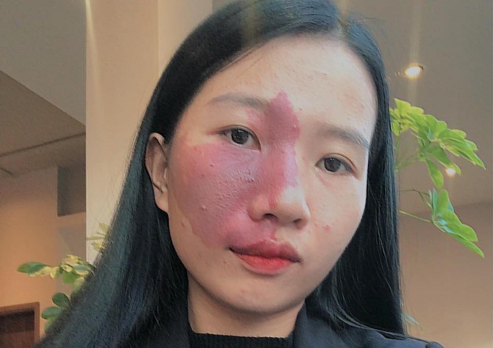 Co giao co vet bot to tren mat: 'Khuyet diem cung can nang niu' hinh anh