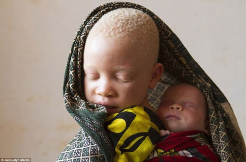  Những người bị bạch tạng ở Tanzania luôn phải đối mặt với những nỗi lo sợ