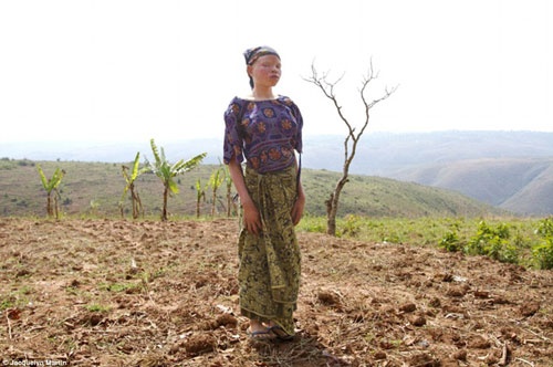 Họ còn phải đối mặt với nguy cơ bị bắt cóc và giết chết bởi những kẻ muốn có một vài bộ phận cơ thể người bạch tạng.