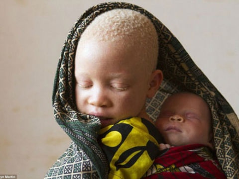 Cuoc song dia nguc cua nguoi bach tang o chau Phi hinh anh