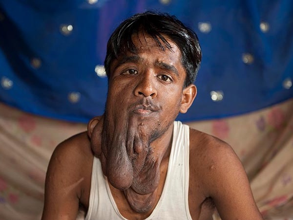 'Nguoi mat voi' An Do tim ban doi sau khi phau thuat hinh anh