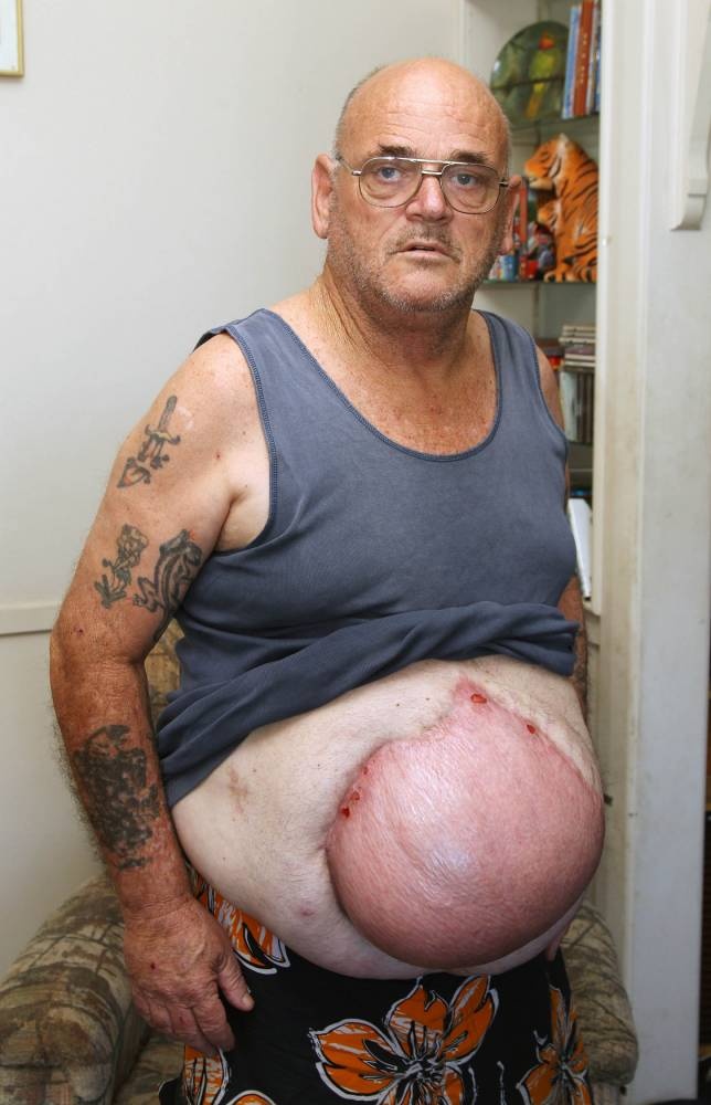 Uong chai bia ban, bung to nhu chua 7 thang hinh anh