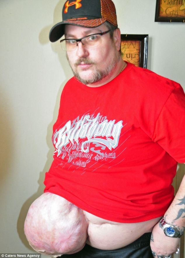 Da day loi ra khoi bung nhu qua bong hinh anh