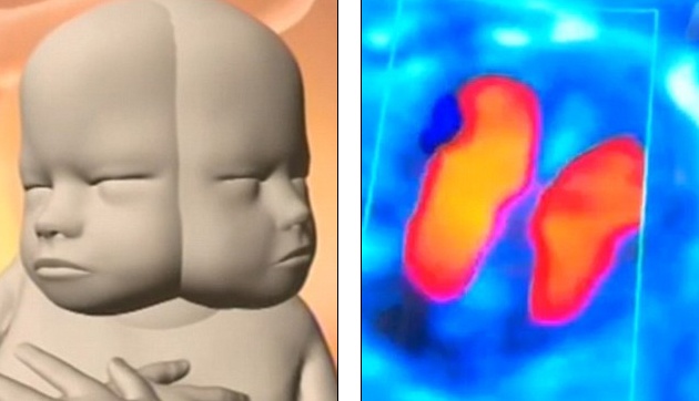 Bao thai nguoi co hai mat va hai nao tai Australia hinh anh