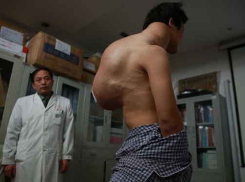 Chang trai cong khoi u 10 kg suot mot thap ky hinh anh