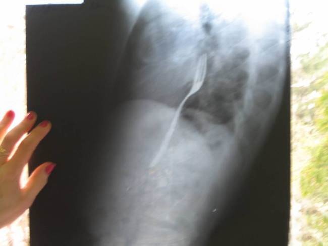 Thanh nien nuot dia vao bung vi thua ca cuoc hinh anh